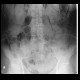 Pneumomediastinum, pneumoretroperitoneum, perforation of sigmoid colon, complication of colonoscopy: X-ray - Plain radiograph